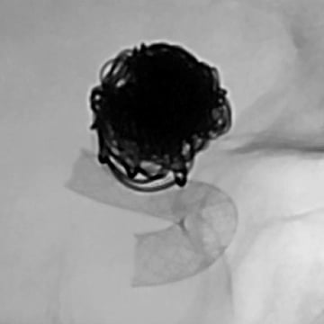 An MRI  scan of an aneurysm