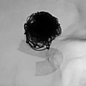 An MRI scan of an aneurysm